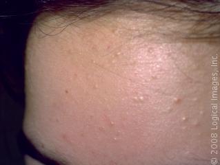 tea tree oil acne