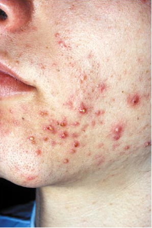 Moderate Acne