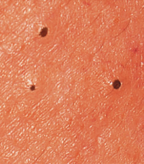 Blackheads