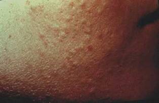 Comedonal Acne