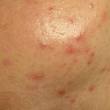 Nodules Acne