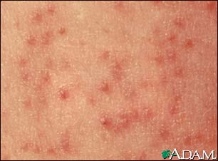 Papules