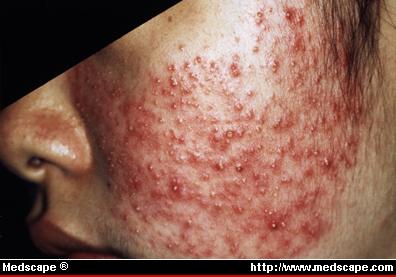 Severe Acne